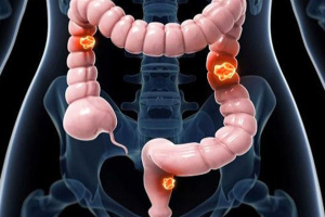 کولورکتال؛ سومین سرطان شایع در اصفهان