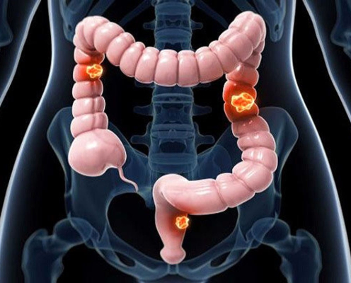 کولورکتال؛ سومین سرطان شایع در اصفهان
