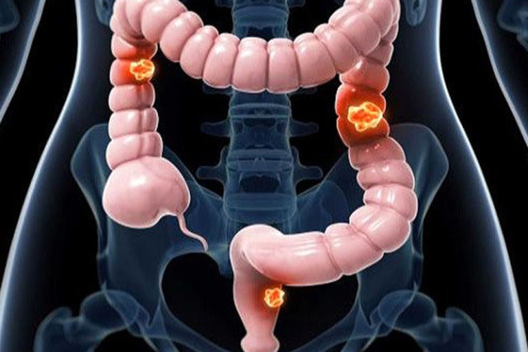 کولورکتال؛ سومین سرطان شایع در اصفهان